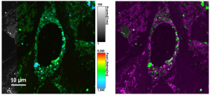 WT-U2OS live cells transfected with a protein labeled with GFP. Lifetime-based pattern matching discriminates GFP signal (green) from autofluorescent background (magenta). Sample courtesy of Musser group, Texas A&M Health Science Center, USA.