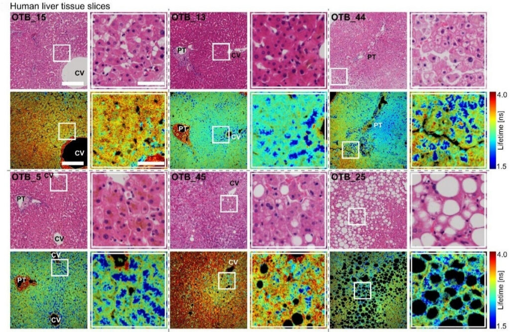 Comparison of conventional H&E histology and FAD autofluorescence fluorescence lifetime imaging microscopy (FLIM) in human liver tissue samples. While H&E primarily captures structural tissue morphology, FLIM reveals spatial metabolic heterogeneity through variations in fluorescence lifetime. Regions with shorter fluorescence lifetimes, shown in blue, are associated with altered metabolic states and are particularly prominent in steatotic tissue. Consecutive tissue sections were used for H&E and FLIM imaging. CV: central vein; PT: portal triad.