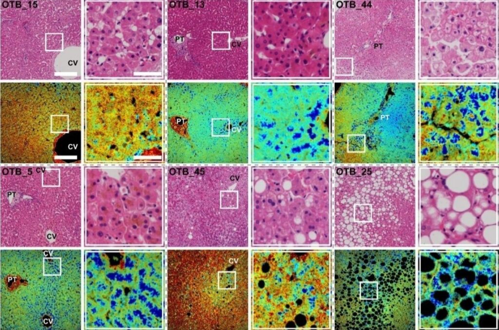 Comparison of conventional H&E histology and FAD autofluorescence fluorescence lifetime imaging microscopy (FLIM) in human liver tissue samples. While H&E primarily captures structural tissue morphology, FLIM reveals spatial metabolic heterogeneity through variations in fluorescence lifetime. Regions with shorter fluorescence lifetimes, shown in blue, are associated with altered metabolic states and are particularly prominent in steatotic tissue. Consecutive tissue sections were used for H&E and FLIM imaging. CV: central vein; PT: portal triad.