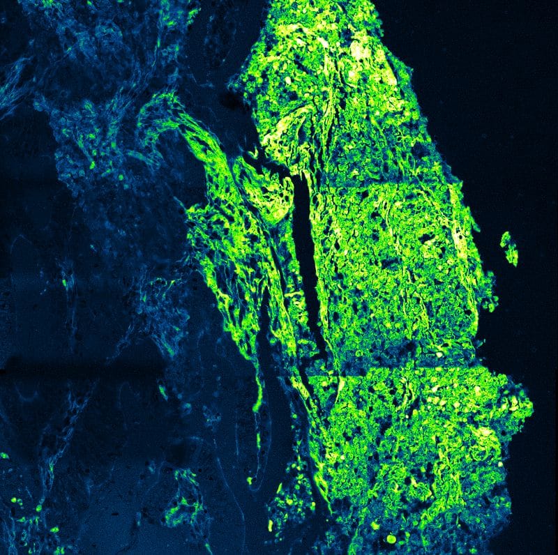 FLIM image of sigmoid colon cancer tissue with hematoxylin and eosin staining. The color scale represents the average fluorescence lifetime within a single spectral channel. Sample courtesy of Desiree Ridder, Bundeswehr Hospital Berlin.