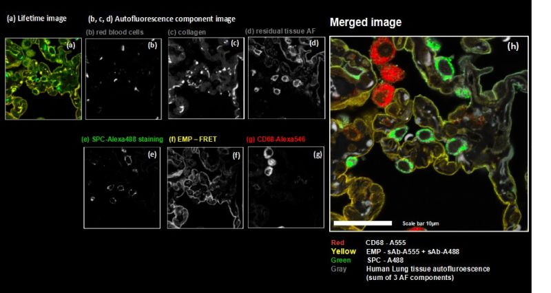 Spectral FLIM-FRET imaging of human lung tissue showing separation of multiple fluorescent labels and autofluorescence components using lifetime and spectral information.